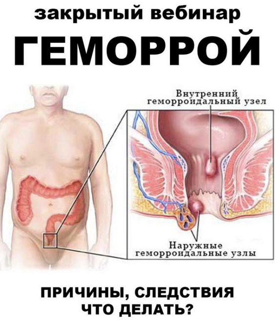 [Женя Братишка, Юля Братишка] [Школа Разумного Покупателя] Геморрой (2024)